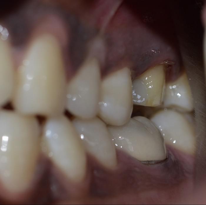 crown root canal
