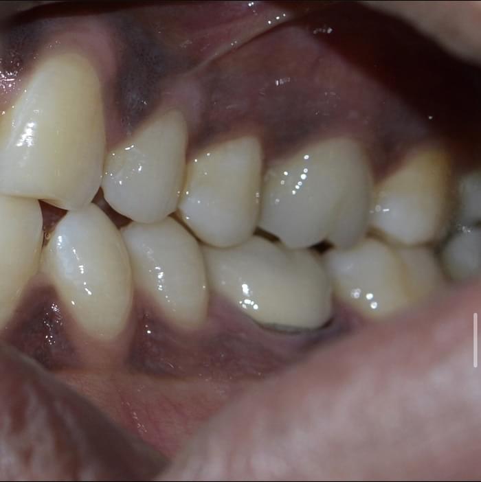 crown root canal