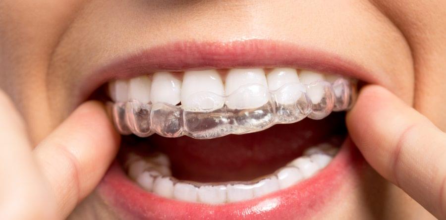 5 Advantages of Invisalign over Traditional Braces