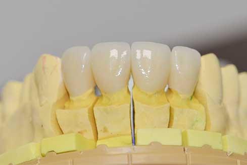 Dental Crowns Surrey BC