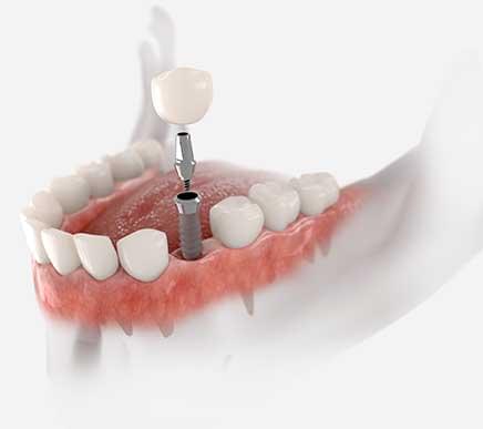 Dental Implants in Surrey